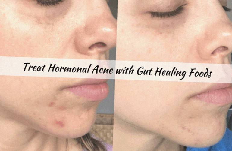 Say Goodbye to Hormonal Acne: Discover the Power of Gut Healing Foods