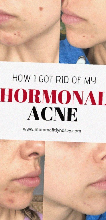 hormonal acne story