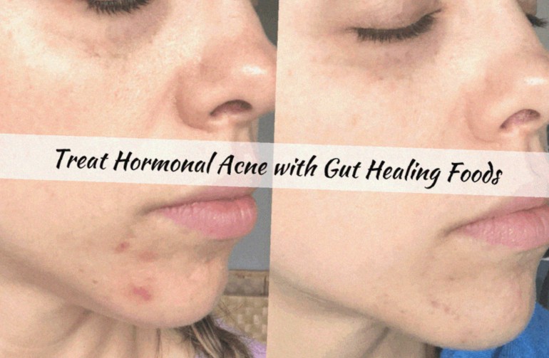 Say Goodbye to Hormonal Acne: Nourish Your Skin from Within